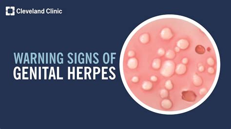 herpes in penus|Genital herpes